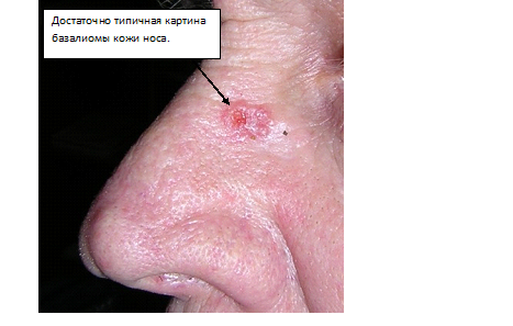 рак кожи на носу фото