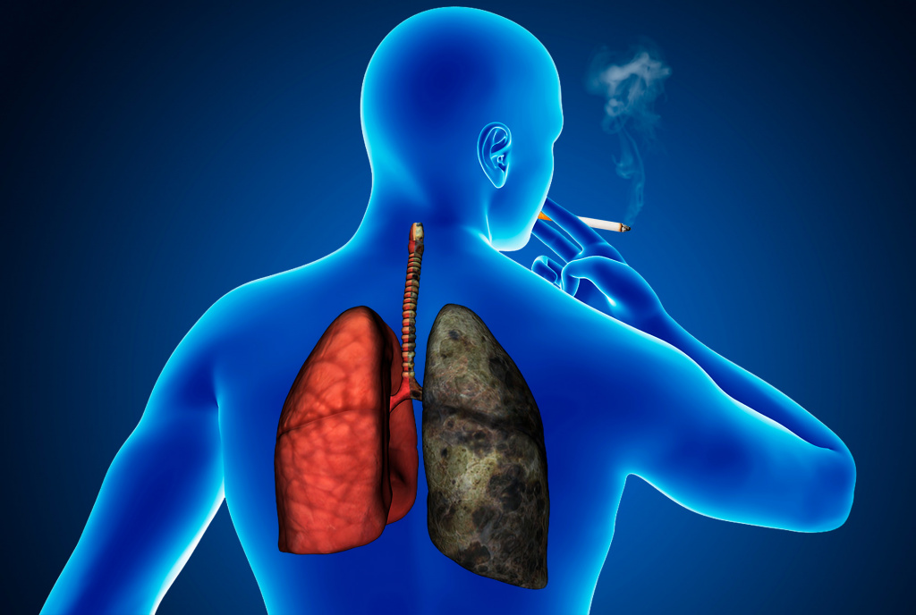 Что делать курильщику, если поставлен диагноз рак?